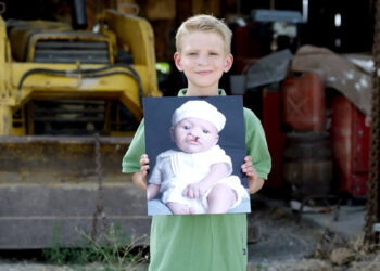 Од естетике до еугенике – абортус чак и због расцепа усне