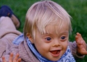 Bambino con sindrome di Down