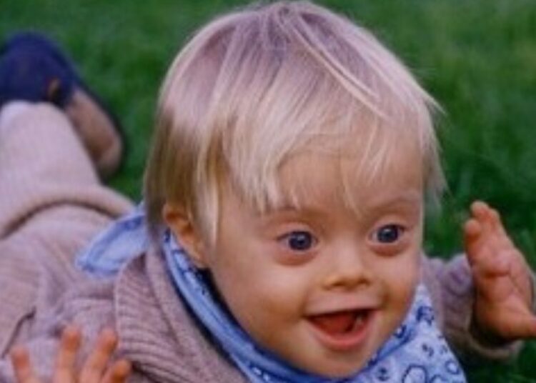 Bambino con sindrome di Down