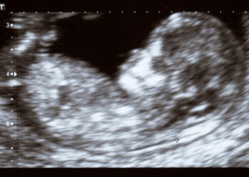 Associated Press lehnt Begriffe wie „fötaler Herzschlag“ und „Spätabtreibung“ ab